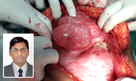 5 kg tumor removed at BSR Cancer Hospital