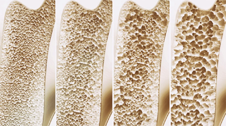 Bone Mineral Loss