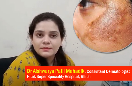 Home remedies can worsen the Melasma situation