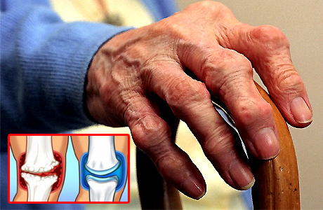 All arthritis have different causes and different treatment