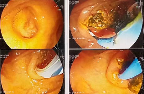 CBD stones removed by ERCP at Hitek
