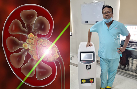 Laser Lithotripsy now available at Aarogyam Hospital Bhilai