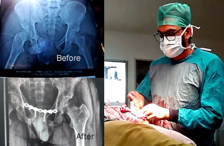 Pelvis Fracture repaired in Hitek Hospital