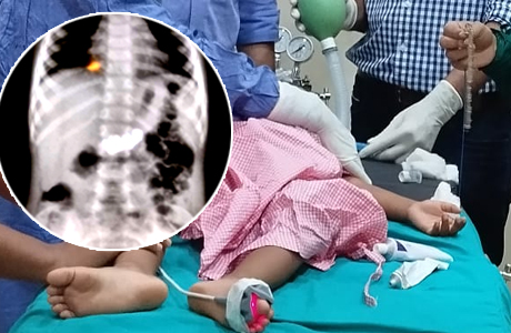 Foreign Article removed from stomach of 2 year old