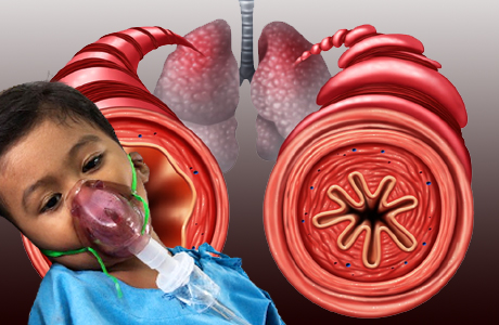 60 pc of children with cough have hyperactive airway disease