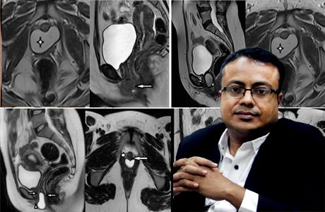 Periurethral cyst operated at Aarogyam