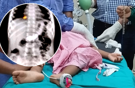 दो साल की बच्ची के पेट से निकली गुमी हुई पाजेब
