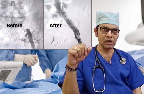 Rare case of Ileac Vein Stenosis treated at Hitek Hospital Bhilai