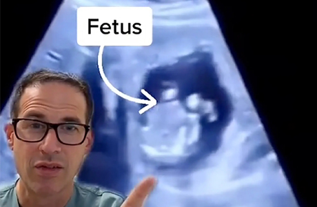 Fetus found in liver of a 30 year old woman