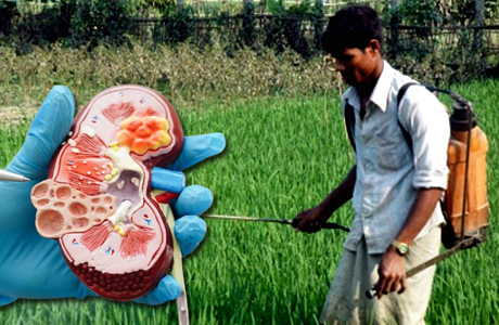 nation grapling under growing numbers of CKD and CKDU