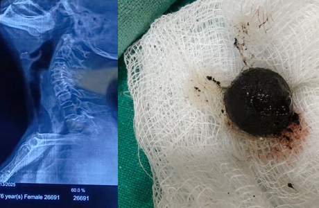 Ayurvedic Pill get stuck in esophagus