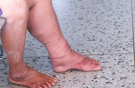 राष्ट्रीय वेक्टर जनित फाइलेरिया उन्मूलन अभियान 25 तक