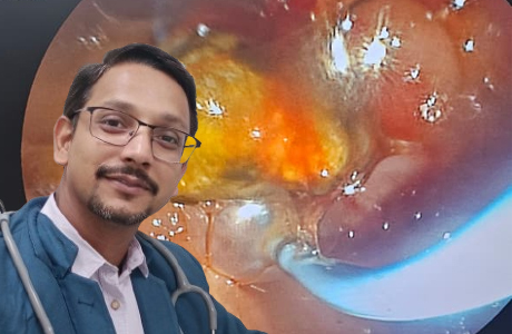 ERCP पद्धति से पित्त की नली से निकाली 3 सेमी की पथरी