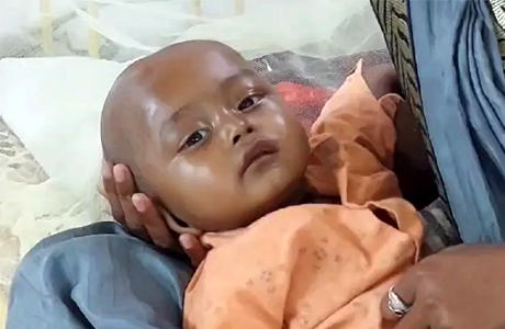 गंभीर कुपोषित बच्चों को एनआरसी लाने पर मिलेगी प्रोत्साहन राशि