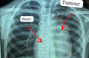 11 साल के बच्चे के दिल से चिपके इन्वेसिव थायमिक कैंसर की सर्जरी
