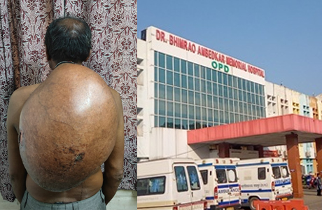 अम्बेडकर अस्पताल में निकाला चिकित्सकीय इतिहास का सबसे बड़ा ट्यूमर