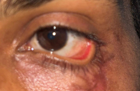 सिम्स में स्किन ग्राफ्टिंग से मरीज की पलक का सफल पुनर्निर्माण