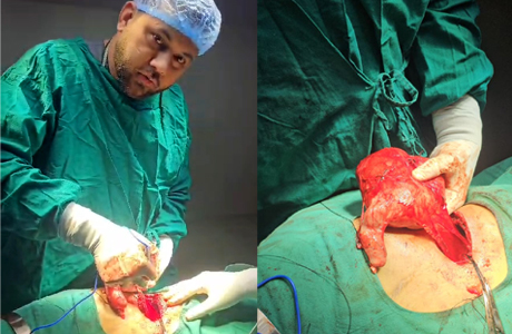 इंसानी हथेली से भी बड़ी हो गई थी किडनी, HiTek में हुई Nephrectomy