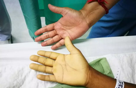 थकान, कमजोरी, सिरदर्द हो सकते हैं एनीमिया के संकेत, इन उपायों को अपनाएं